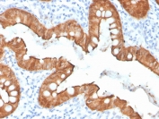IHC staining of FFPE human colon with recombinant Villin antibody (clone VIL1/4107R). HIER: boil tissue sections in pH 9 10mM Tris with 1mM EDTA for 20 min and allow to cool before testing.