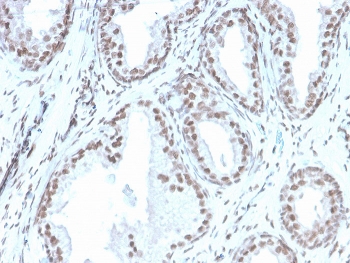 IHC staining of FFPE human prostate with recombinant ATRX antibody (clone rATRX/3446). HIER: boil tissue sections in pH 9 10mM Tris with 1mM EDTA for 20 min and allow to cool before testing.~
