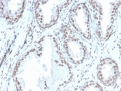 IHC staining of FFPE human prostate with recombinant ATRX antibody (clone rATRX/3446). HIER: boil tissue sections in pH 9 10mM Tris with 1mM EDTA for 20 min and allow to cool before testing.