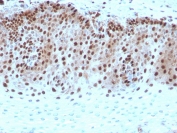 IHC staining of FFPE human cervical carcinoma with recombinant c-Myc antibody. HIER: boil tissue sections in pH 9 10mM Tris with 1mM EDTA for 20 min and allow to cool before testing.