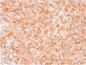 IHC staining of FFPE human melanoma with CD63 antibody (clone LAMP3/3315). HIER: boil tissue sections in pH 9 10mM Tris with 1mM EDTA for 20 min and allow to cool before testing.