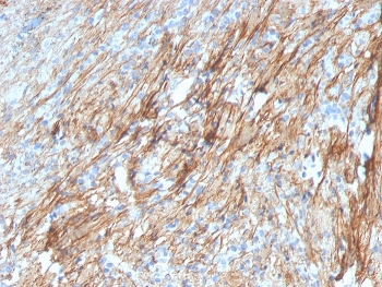 IHC staining of FFPE human lung with Fibronectin antibody (clone FN1/3029). HIER: boil tissue sections in pH 9 10mM Tris with 1mM EDTA for 20 min and allow to cool before testing.