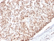 IHC staining of FFPE human breast carcinoma with Estrogen Receptor alpha antibody (clone ESR1/3565). HIER: boil tissue sections in pH 9 10mM Tris with 1mM EDTA for 20 min and allow to cool before testing.