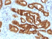IHC staining of FFPE human prostate carcinoma with recombinant AMACR antibody (clone AMACR/3931R). HIER: boil tissue sections in pH 9 10mM Tris with 1mM EDTA for 20 min and allow to cool before testing.