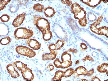 IHC staining of FFPE human renal cell carcinoma with recombinant AMACR antibody. HIER: boil tissue sections in pH 9 10mM Tris with 1mM EDTA for 20 min and allow to cool before testing.~