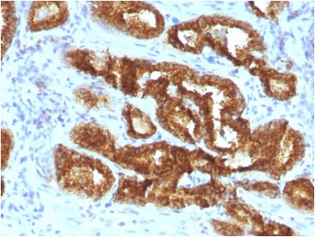IHC staining of FFPE human prostate carcinoma with