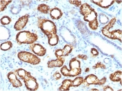 IHC staining of FFPE human renal cell carcinoma with recombinant AMACR antibody (clone AMACR/3931R). HIER: boil tissue sections in pH 9 10mM Tris with 1mM EDTA for 20 min and allow to cool before testing.