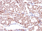 IHC staining of FFPE human breast carcinoma with Estrogen Receptor alpha antibody (clone ESR1/3564). HIER: boil tissue sections in pH 9 10mM Tris with 1mM EDTA for 20 min and allow to cool before testing.
