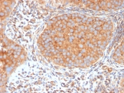 IHC staining of FFPE human urothelial carcinoma with SERBP1 antibody (clone SERBP1/3494). HIER: boil tissue sections in pH 9 10mM Tris with 1mM EDTA for 20 min and allow to cool before testing.