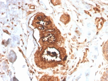 IHC staining of FFPE human breast carcinoma with recombinant Mammaglobin antibody (clone MGB/4058R). HIER: boil tissue sections in pH 9 10mM Tris with 1mM EDTA for 20 min and allow to cool before testing.~