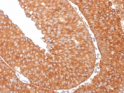 IHC staining of FFPE human urothelial carcinoma with SERBP1 antibody. HIER: boil tissue sections in pH 9 10mM Tris with 1mM EDTA for 20 min and allow to cool before testing.