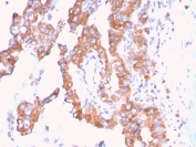 IHC staining of FFPE human urothelial carcinoma with SERBP1 antibody. HIER: boil tissue sections in pH 9 10mM Tris with 1mM EDTA for 20 min and allow to cool before testing.
