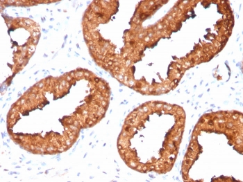 IHC staining of FFPE human prostate carcinoma with recombinant PSA antibody (clone KLK3/4551R). HIER: boil tissue sections in pH 9 10mM Tris with 1mM EDTA for 20 min and allow to cool before testing.~