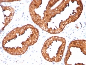 IHC staining of FFPE human prostate carcinoma with recombinant PSA antibody (clone KLK3/4551R). HIER: boil tissue sections in pH 9 10mM Tris with 1mM EDTA for 20 min and allow to cool before testing.