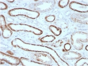 IHC staining of FFPE human renal cell carcinoma with Carbonic Anhydrase IX antibody (clone CA9/3405). HIER: boil tissue sections in pH 9 10mM Tris with 1mM EDTA for 20 min and allow to cool before testing.
