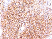 IHC staining of FFPE human lung squamous cell carcinoma with EGFR antibody (clone GFR/2596). HIER: boil tissue sections in pH 9 10mM Tris with 1mM EDTA for 20 min and allow to cool before testing.