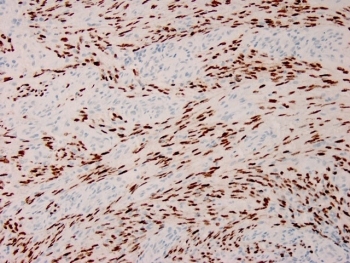 IHC staining of FFPE human Karposi's sarcoma with recombinant HHV8 antibody. HIER: boil tissue sections in pH 9 10mM Tris with 1mM EDTA for 20 min and allow to cool before testing.~