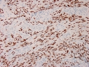 IHC staining of FFPE human Karposi's sarcoma with recombinant HHV8 antibody. HIER: boil tissue sections in pH 9 10mM Tris with 1mM EDTA for 20 min and allow to cool before testing.