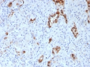 IHC staining of FFPE human lung adenocarcinoma with Napsin A antibody (clone NAPSA/3307). HIER: boil tissue sections in pH 9 10mM Tris with 1mM EDTA for 20 min and allow to cool before testing.