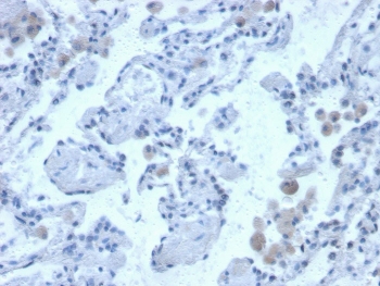 IHC staining of FFPE human lung with Cystatin B antibody. HIER: boil tissue sections in pH 9 10mM Tris with 1mM EDTA for 20 min and allow to cool before testing.~