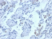 IHC staining of FFPE human lung with Cystatin B antibody. HIER: boil tissue sections in pH 9 10mM Tris with 1mM EDTA for 20 min and allow to cool before testing.