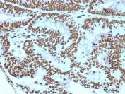 IHC staining of FFPE human breast carcinoma with ZNF846 antibody. HIER: boil tissue sections in pH 9 10mM Tris with 1mM EDTA for 20 min and allow to cool before testing.