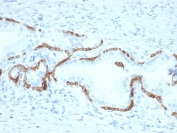 IHC staining of FFPE human prostate carcinoma with Cytokeratin 5/6 antibody (clone KRT5.6/2090). HIER: boil tissue sections in pH 9 10mM Tris with 1mM EDTA for 20 min and allow to cool before testing.