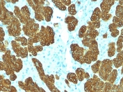IHC staining of FFPE human basal cell carcinoma with Cytokeratin 5/6 antibody (clone KRT5.6/2090). HIER: boil tissue sections in pH 9 10mM Tris with 1mM EDTA for 20 min and allow to cool before testing.
