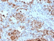 IHC staining of FFPE human lymph node with TIM3 antibody (clone TIM3/4028). HIER: boil tissue sections in pH 9 10mM Tris with 1mM EDTA for 20 min and allow to cool before testing.
