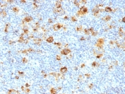 IHC staining of FFPE human Hodgkin's lymphoma with CD15 antibody (clone MY-1). HIER: boil tissue sections in pH 9 10mM Tris with 1mM EDTA for 20 min and allow to cool before testing.