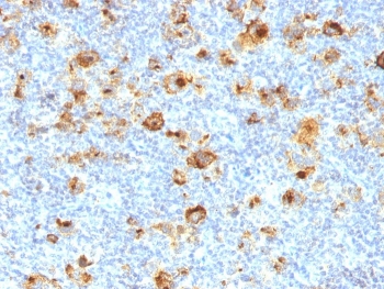 IHC staining of FFPE human Hodgkin's lymphoma with CD15 antibody (clone MY-1). HIER: boil tissue sections in pH 9 10mM