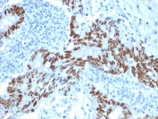 IHC staining of FFPE human colon carcinoma with TP53 antibody (clone PCRP-TP53-1F7). HIER: boil tissue sections in pH 9 10mM Tris with 1mM EDTA for 20 min and allow to cool before testing.