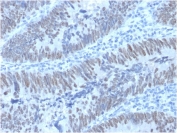 IHC staining of FFPE human colon carcinoma with CDX2 antibody (clone PCRP-CDX2-1A3). HIER: boil tissue sections in pH 9 10mM Tris with 1mM EDTA for 20 min and allow to cool before testing.