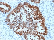 IHC staining of FFPE human colon carcinoma with p53 antibody (clone PCRP-TP53-2A10). HIER: boil tissue sections in pH 9 10mM Tris with 1mM EDTA for 20 min and allow to cool before testing.