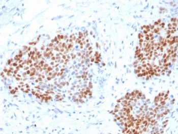 IHC staining of FFPE human pancreas with recombinant SOX9 antibody. HIER: boil tissue sections in pH 9 10mM Tris with 1mM EDTA for 20 min and allow to cool before testing.~