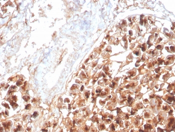 IHC staining of FFPE human pancreas with recombinant Eosinophil Peroxidase antibody (clone rEPO104). HIER: boil tissue sections in pH 9 10mM Tris with 1mM EDTA for 20 min and allow to cool before testing.~