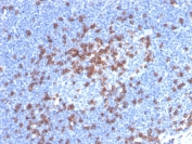 IHC staining of FFPE human lymph node with recombinant CD8A antibody. HIER: boil tissue sections in pH 9 10mM Tris with 1mM EDTA for 20 min and allow to cool before testing.