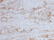 IHC staining of FFPE human colon with CD151 antibody (clone 11G5a). HIER: boil tissue sections in pH 9 10mM Tris with 1mM EDTA for 20 min and allow to cool before testing.