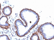 IHC staining of FFPE human breast carcinoma with recombinant Ferritin Light Chain antibody (clone FTL/3872R). HIER: boil tissue sections in pH 9 10mM Tris with 1mM EDTA for 20 min and allow to cool before testing.