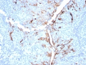IHC staining of FFPE human lung mesothelioma with Mesothelin antibody (clone MSLN/3384). HIER: boil tissue sections in pH 9 10mM Tris with 1mM EDTA for 20 min and allow to cool before testing.