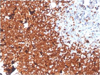 IHC staining of FFPE human thymus with TdT antibody. HIER: boil tissue sections in pH 9 10mM Tris with 1mM EDTA for 20 min and allow to cool before testing.