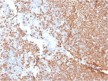 IHC staining of FFPE human thymus with TdT antibody. HIER: boil tissue sections in pH 9 10mM Tris with 1mM EDTA for 20 min and allow to cool before testing.