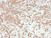 IHC staining of FFPE human liver with Factor VII antibody (clone F7/3513). HIER: boil tissue sections in pH 9 10mM Tris with 1mM EDTA for 20 min and allow to cool before testing.
