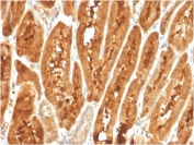 IHC staining of FFPE human liver carcinoma with FABP1 antibody (clone FABP1/3487). HIER: boil tissue sections in pH 9 10mM Tris with 1mM EDTA for 20 min and allow to cool before testing.