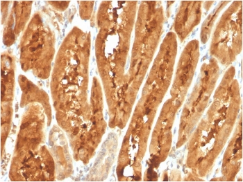 IHC staining of FFPE human liver carcinoma with FABP1 antibody. HIER: boil tissue sections in pH 9 10mM Tris with 1mM EDTA for 20 min and allow to cool before testing.