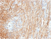 IHC staining of FFPE human lung with Fibronectin antibody (clone FN1/3036). HIER: boil tissue sections in pH 9 10mM Tris with 1mM EDTA for 20 min and allow to cool before testing.