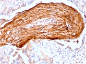 IHC staining of FFPE human lung with Fibronectin antibody (clone FN1/3045). HIER: boil tissue sections in pH 9 10mM Tris with 1mM EDTA for 20 min and allow to cool before testing.
