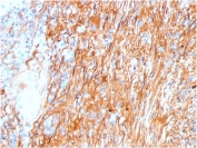 IHC staining of FFPE human lung with Fibronectin antibody (clone FN1/3045). HIER: boil tissue sections in pH 9 10mM Tris with 1mM EDTA for 20 min and allow to cool before testing.