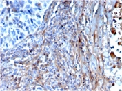 IHC staining of FFPE human lung with Fibronectin antibody (clone FN1/3568). HIER: boil tissue sections in pH 9 10mM Tris with 1mM EDTA for 20 min and allow to cool before testing.