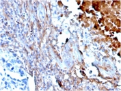 IHC staining of FFPE human lung with Fibronectin antibody (clone FN1/3568). HIER: boil tissue sections in pH 9 10mM Tris with 1mM EDTA for 20 min and allow to cool before testing.